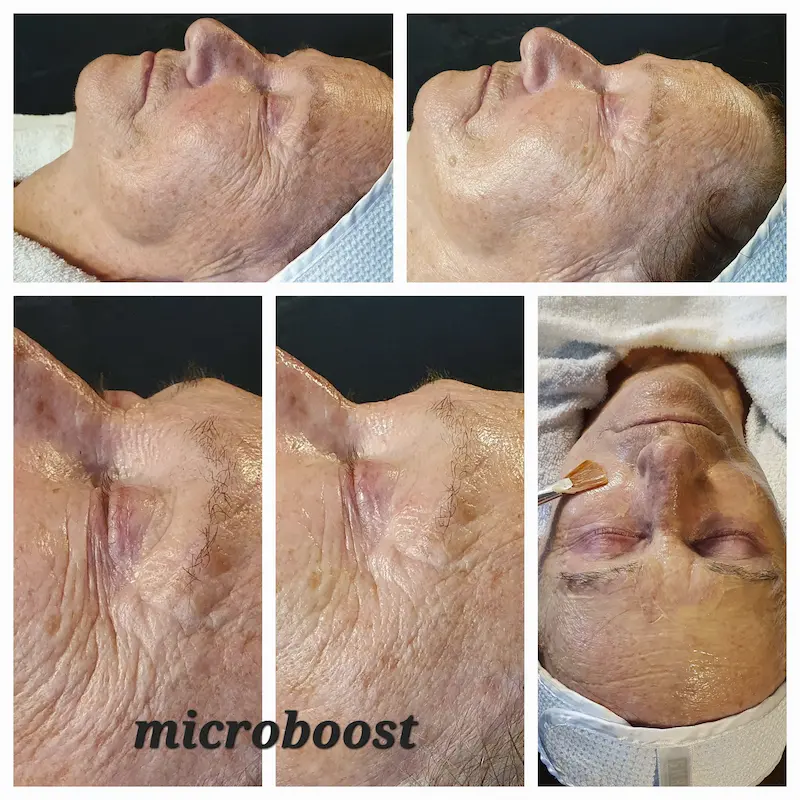 Microboost (2)