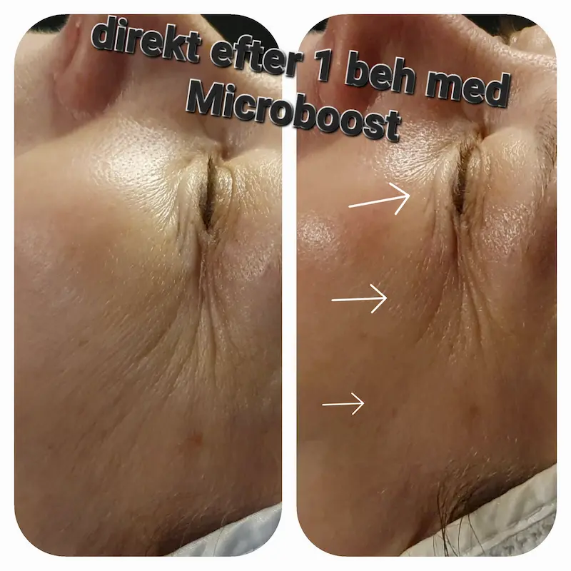 Microboost (3)