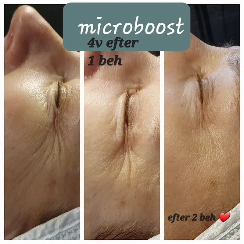 Microboost (5)